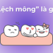 Lệch mông là gì?